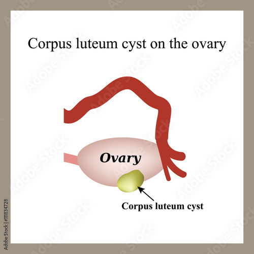 Corpus luteum cyst on the ovary. Functional cyst. Ovary. Infographics. Vector illustration on isolated background