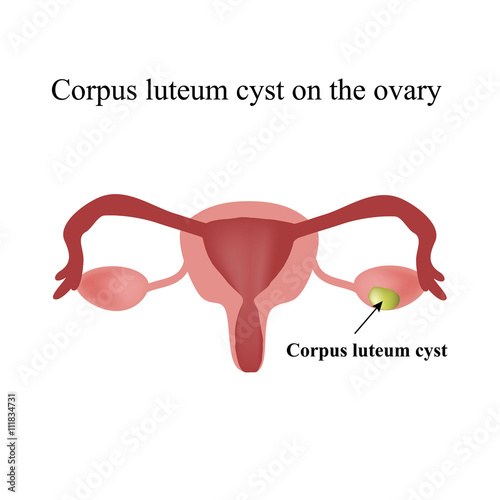 Corpus luteum cyst on the ovary. Functional cyst. Ovary. Infographics. Vector illustration on isolated background