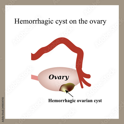 Hemorrhagic cyst on the ovary. Ovary. Infographics. Vector illustration on isolated background photo