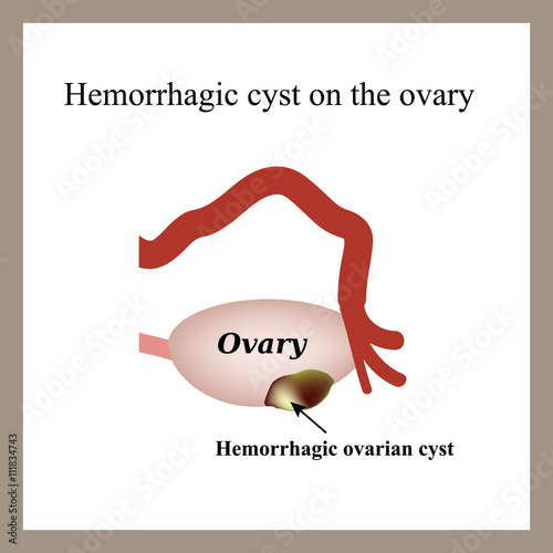 Hemorrhagic cyst on the ovary. Ovary. Infographics. Vector illustration on isolated background