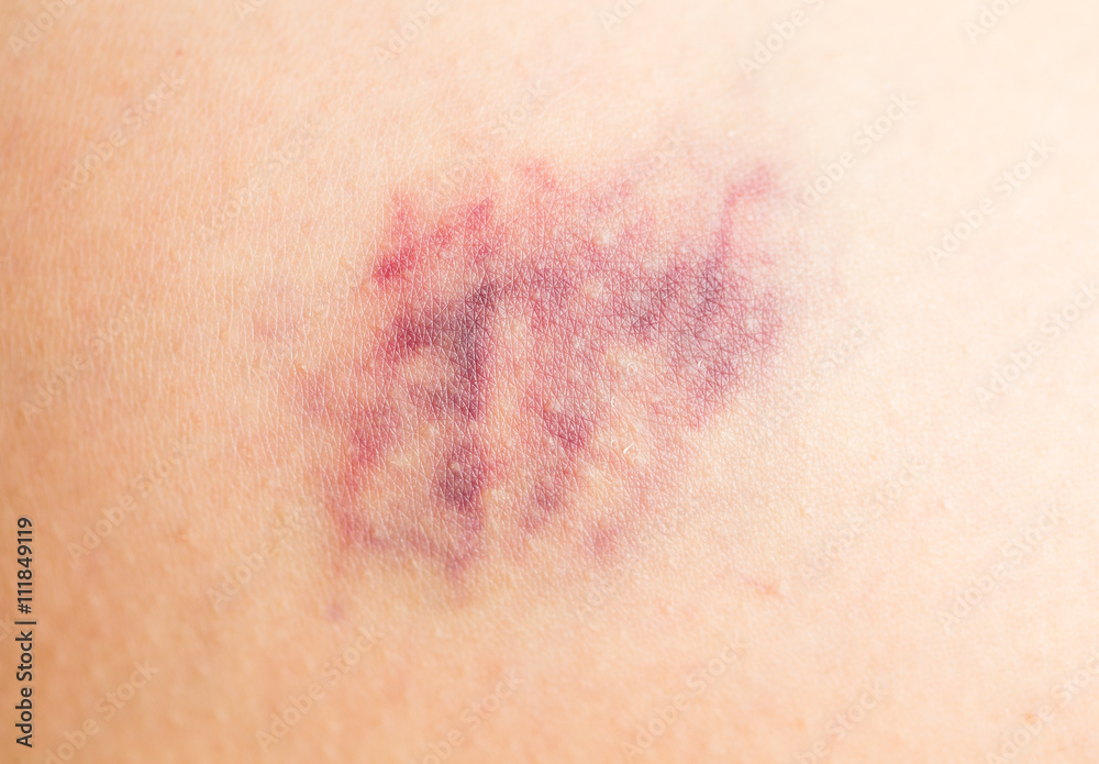 Fototapeta premium Bruise on human leg