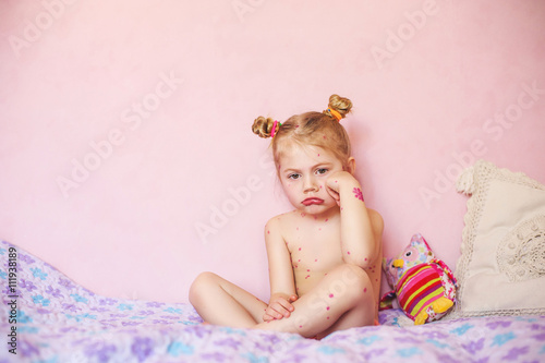 Obraz na plátně baby sitting on bed with chicken pox rash, natural photo