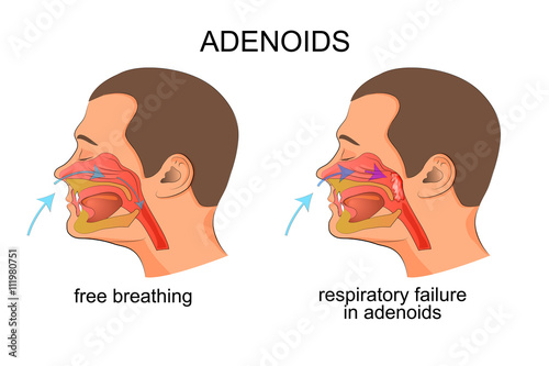 adenoiditis, respiratory failure photo