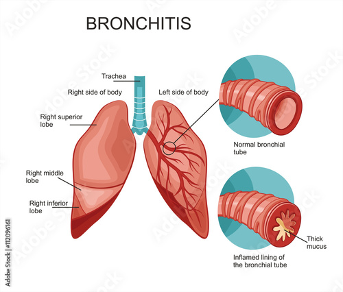 Bronchitis photo