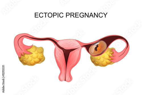 uterus with ectopic pregnancy photo