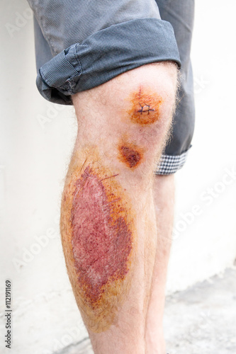 abrasion