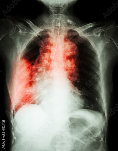Lung cancer .  Film chest x-ray show right lung mass , wide mediastinum , pneumonia and right pleural effusion photo