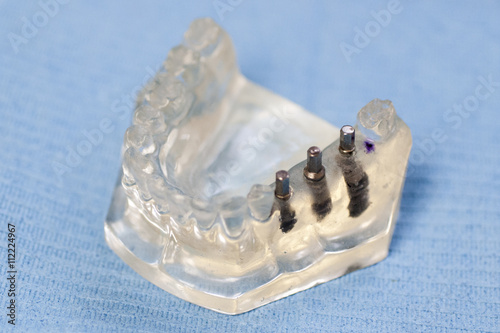 Protesi dentale