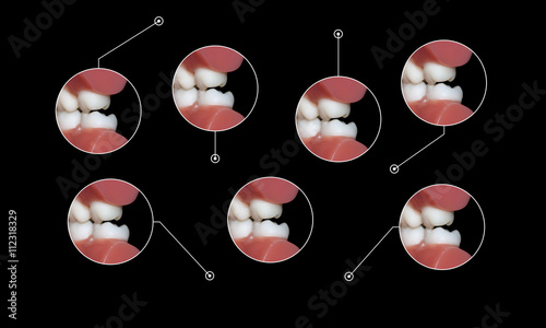 Obraz na plátně dental occlusion molars teeth infographic elements