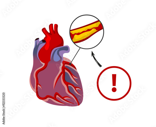 The risk of heart failure