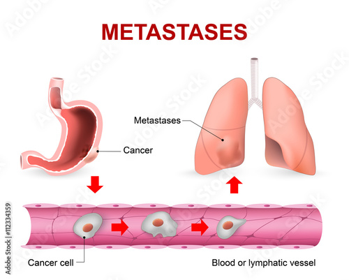 Cancer cells, cancer foci and Metastases