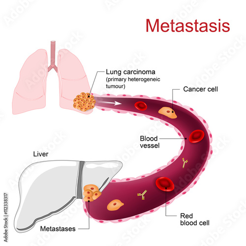 Metastasis. Metastases photo
