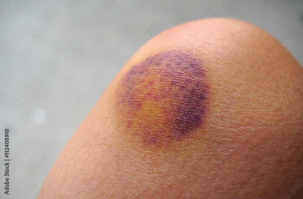 Bruise on wounded woman leg skin Bruise on wounded woman leg skin
