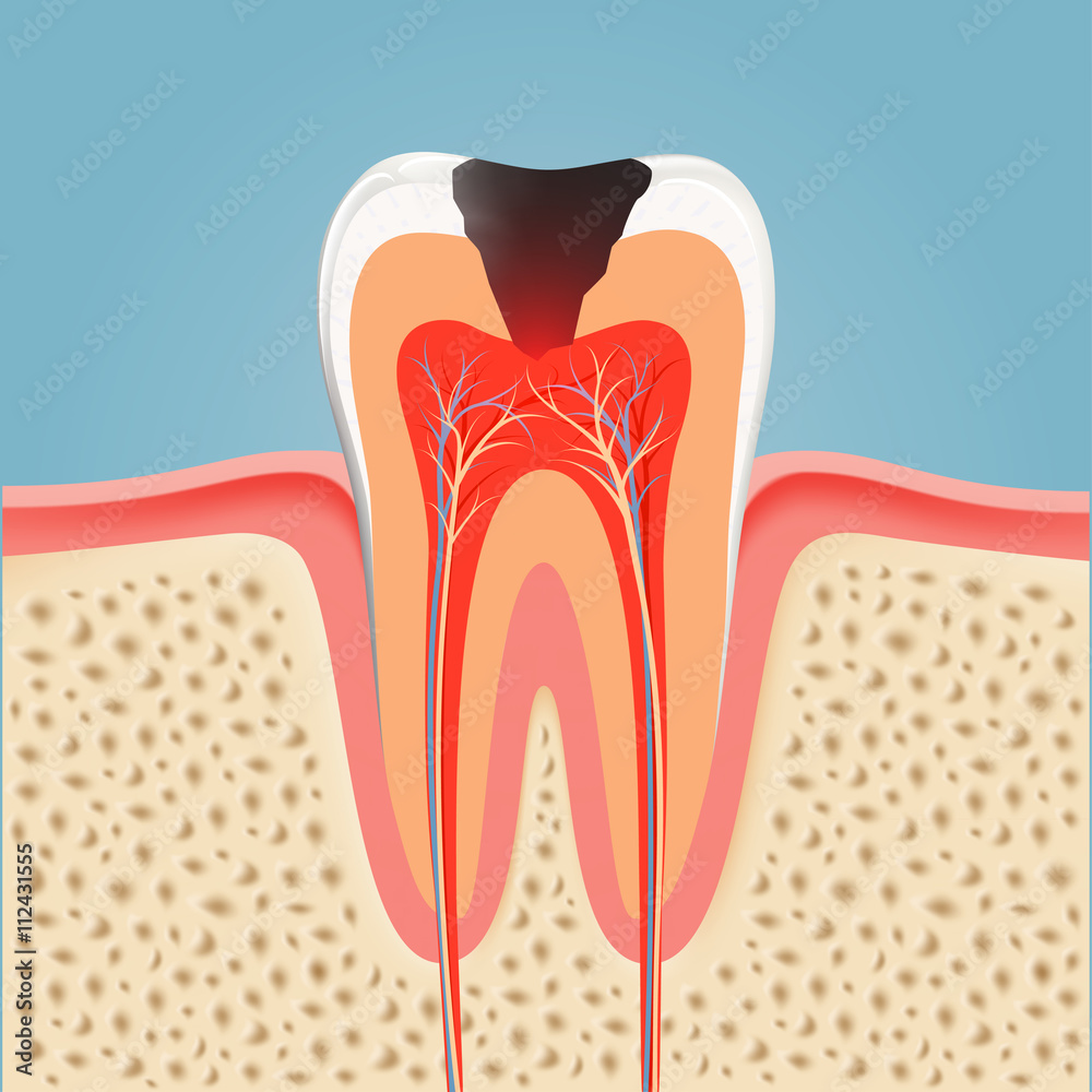 Human tooth with caries. Stock vector Human tooth with caries. Stock vector