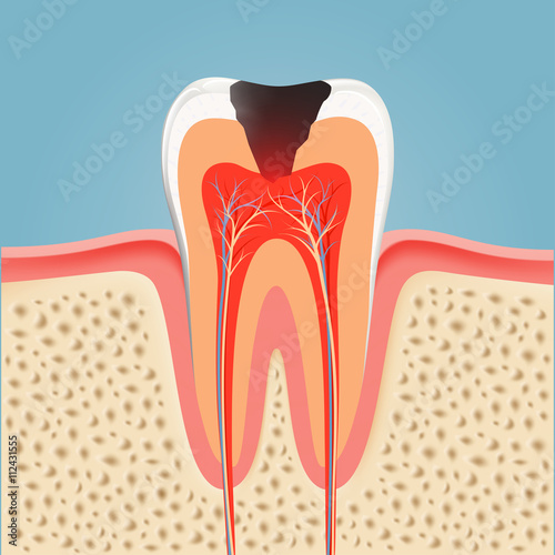 Human tooth with caries. Stock vector