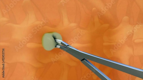 Spinal & Epidural anaesthesia