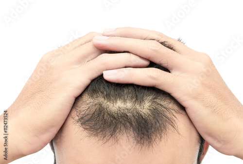 Young man serious hair loss problem for hair loss concept