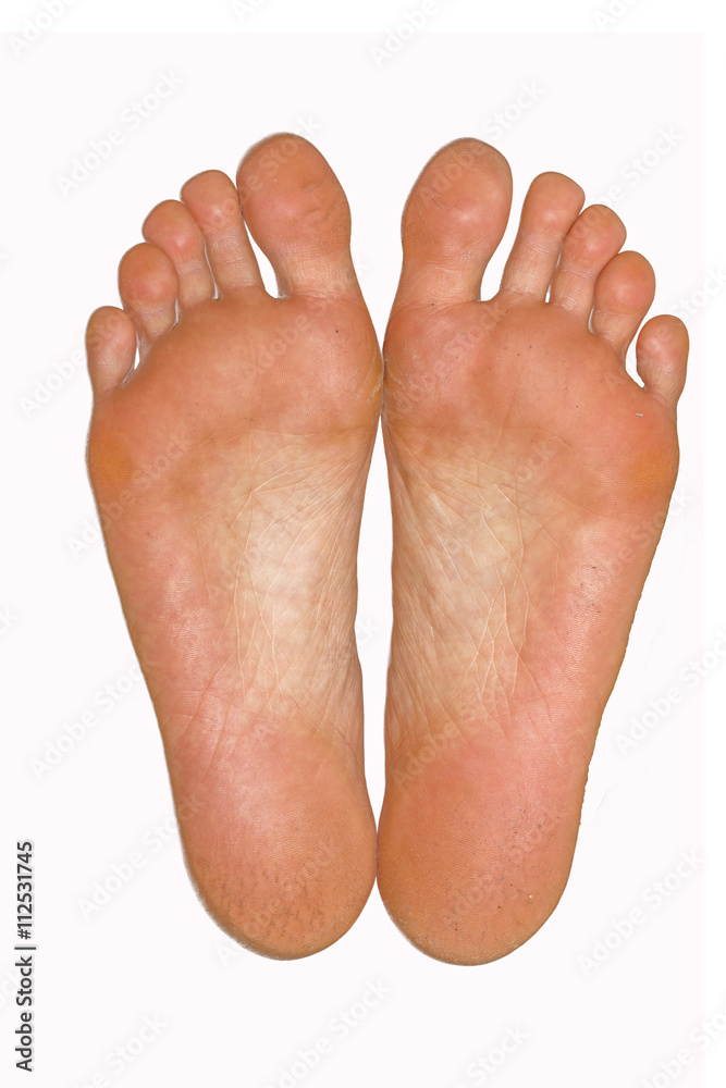 Fototapeta premium broken foot