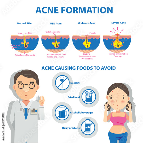  Acne/ Acne formation Info Graphic and diagrams.Vector illustrations