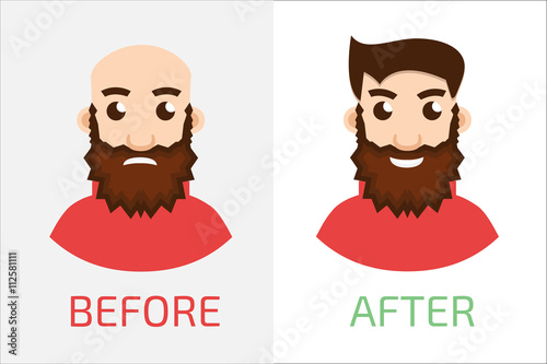 Stages Of Hair Loss new before and after