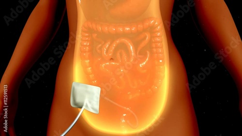 Peritoneal dialysis
