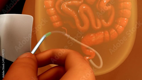 Peritoneal dialysis