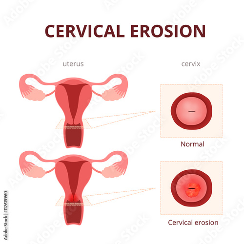 cervical erosion schematic illustration photo