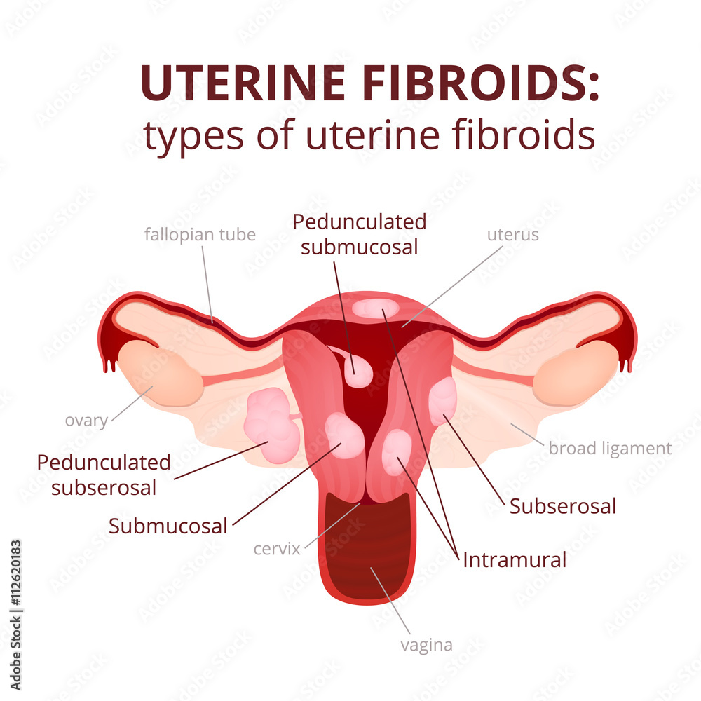 Fotografie uterine fibroids schematic illustration