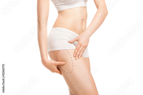 Woman with outlines for plastic surgery on body