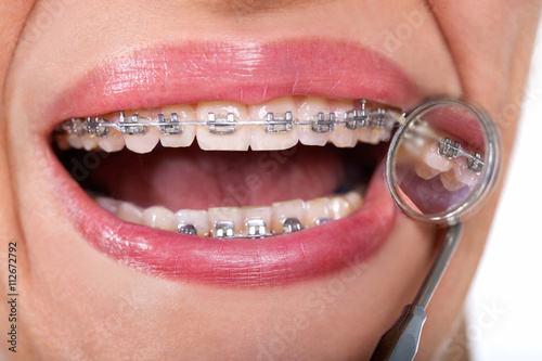Female patient showing her lingual braces on dental mirror