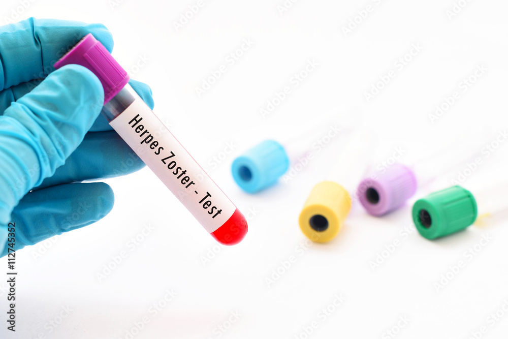 Blood sample for herpes zoster test Stock Photo Adobe Stock