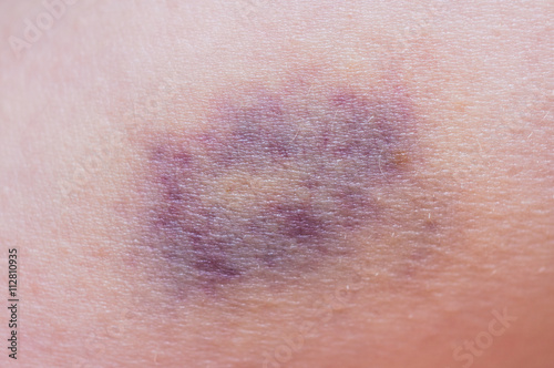 Macro shot of purple bruise on skin. photo