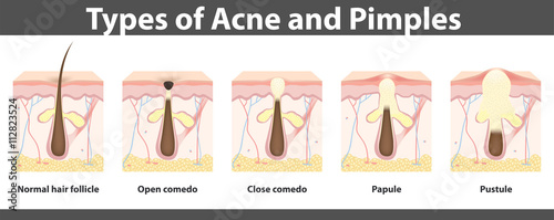 Types of acne,  structure of  pimple, vector illustration