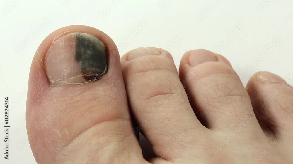 Video Stock Bruise under the nail of big toe. Trauma of toenail