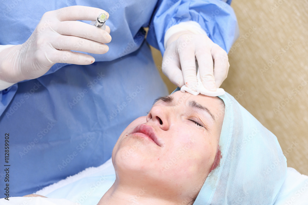 Bio-revitalization with hyaluronic acid treatment of mimic wrink Bio-revitalization with hyaluronic acid treatment of mimic wrink