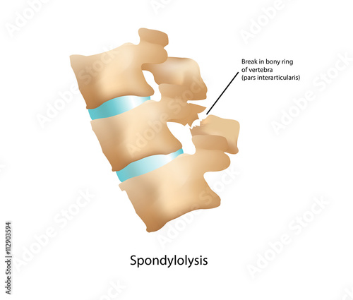 Spondylolysis