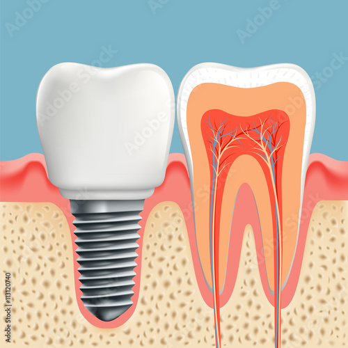 Human tooth in cross-section and dental implant. Stock vector il