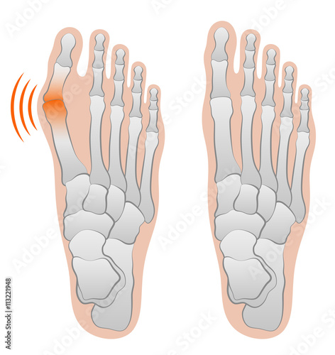 Valgus deformity