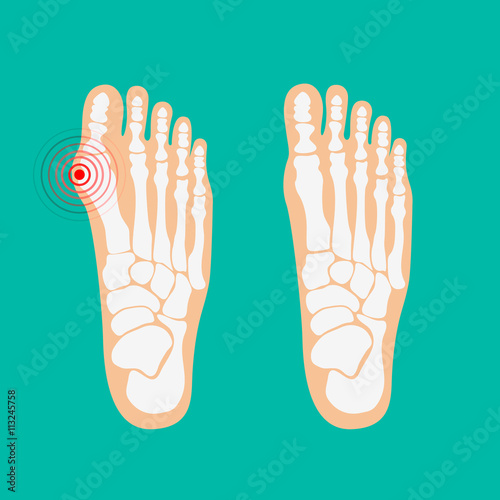 Valgus deformity of the big toe. Foot health care. photo