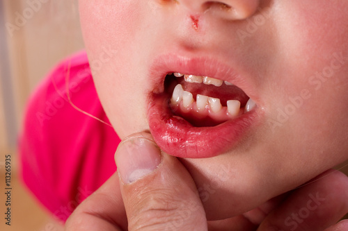 Kind mit Platzwunde an der Lippe nach einem Sturz photo