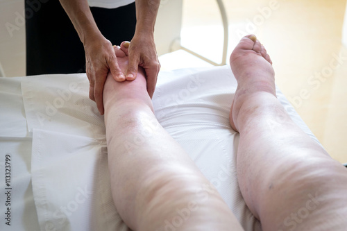 Terapista che esegue il massaggio linfodrenante  manuale su gambe con problemi di edema linfatico © vpardi