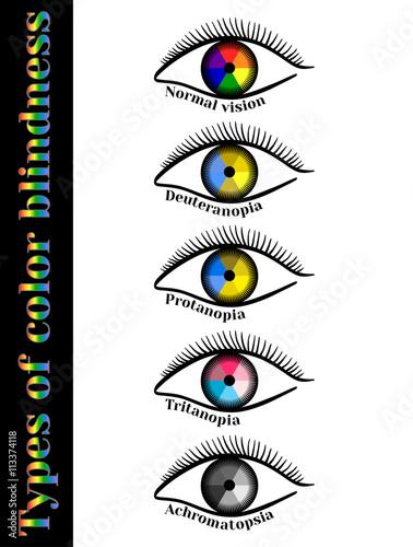 Types of color blindness. Violation of color perception: deuteranopia, protanopia, tritanopia, achromatopsia.    photo