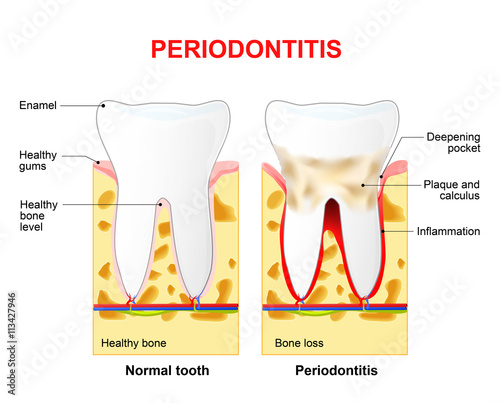 Periodontitis or pyorrhea photo