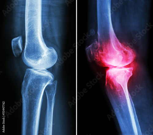 normal knee ( left image ) and osteoarthritis knee ( right image ) ( lateral view )