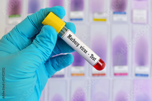 Test tube with blood sample for Marburg virus test  