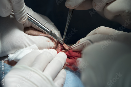 plastic surgery close-up with nose bridge tissues cutting by surgical scissors