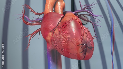 Myocardial Infarction