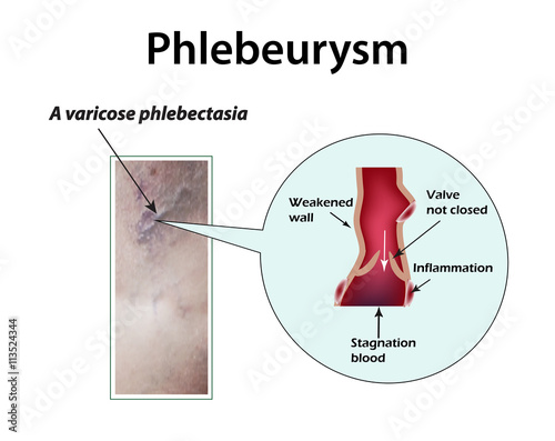 Varicose veins bronchiectasis. Phlebeurysm. Thrombosis. Thrombophlebitis. Infographics. Vector illustration on isolated background