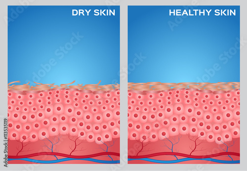 Dry skin, healthy skin texture , vector