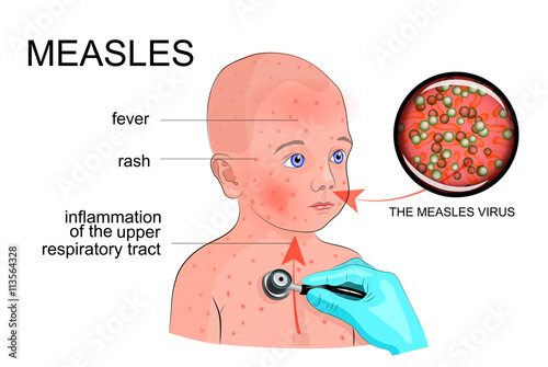 the boy with the symptoms of rubella or measles photo